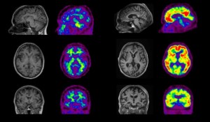 $1 million in funding for dementia research