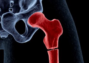 Home visits help hip fracture patients